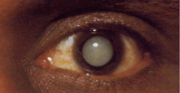 Cataract